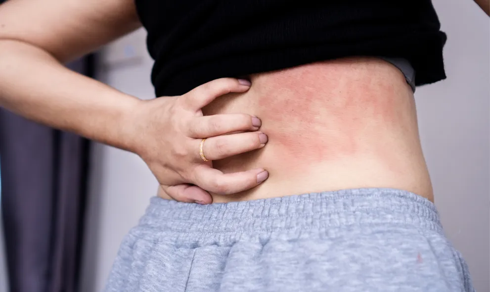 Woman suffering from skin rash due to stress