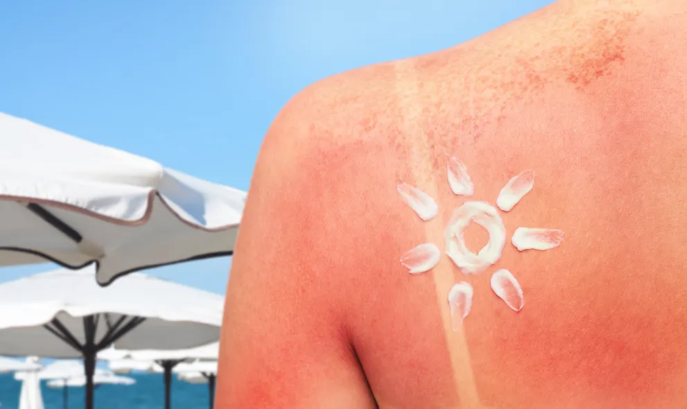 Woman with sunburned skin on beach